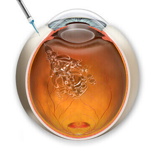 Tratamento Ocular com Antiangiogênico