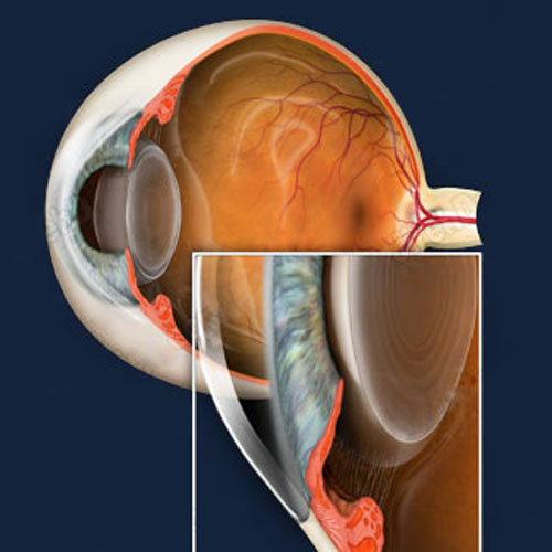 Cicloterapia para glaucoma